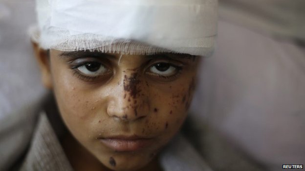 طفل مصاب العدوان على غزة