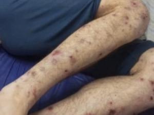 شهادات مروعة من سجن "عوفر": انتشـار كـارثي لـمرض "الجرب" كأداة تعذيب والأسرى ينامون على ملابسهم