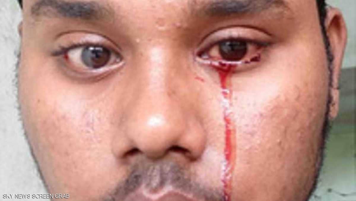 شاب يبكي دما.. ونتائج فحوصاته تحير الأطباء