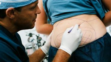 شفط الدهون تجميل أم ضرورة صحية؟